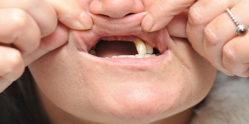 Giải mã chiêm bao rụng răng hàm trên